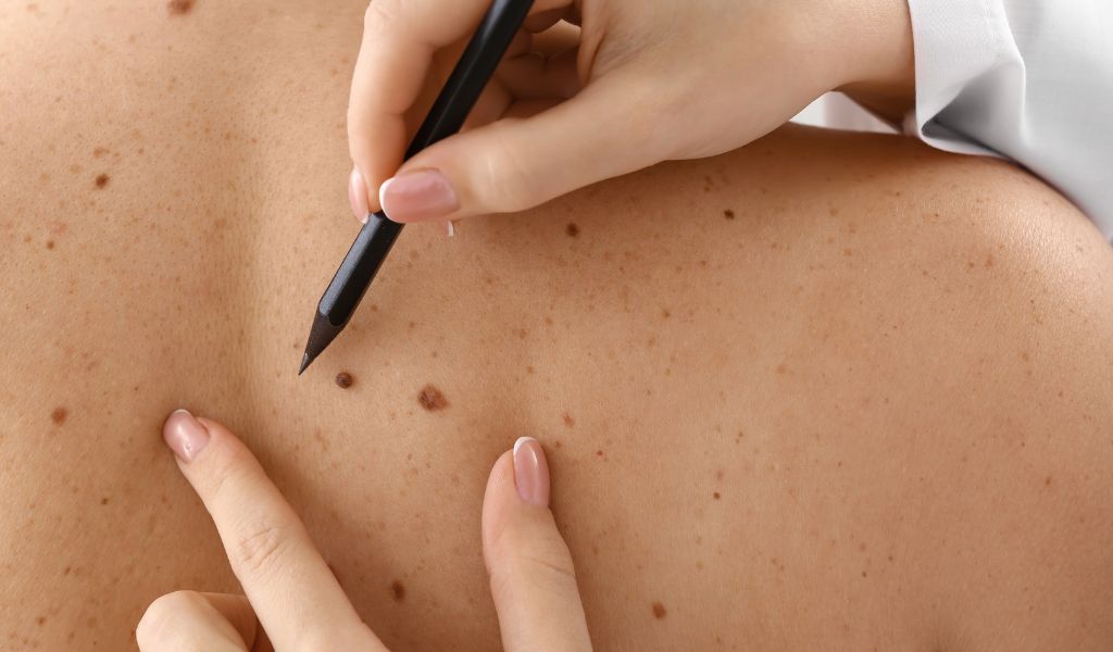 a laady having a skin blemish removal treatment at SF Aesthetics Daventry.
