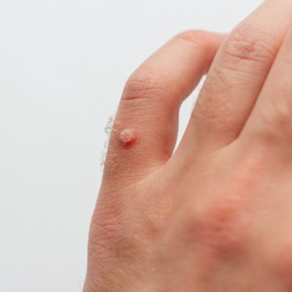 a skin wart on a persons pinky finger on the left hand