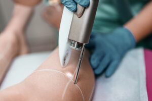 laser hair removal on leg at Sf Aesthetics Daventry