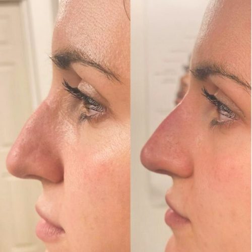 a before and after of a rhinoplasty treatment, at SF Aesthetics Daventry