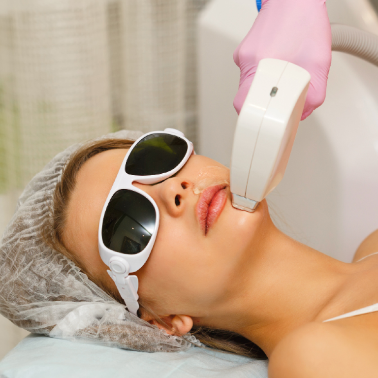 carbon laser facial at SF Aesthetics Daventry