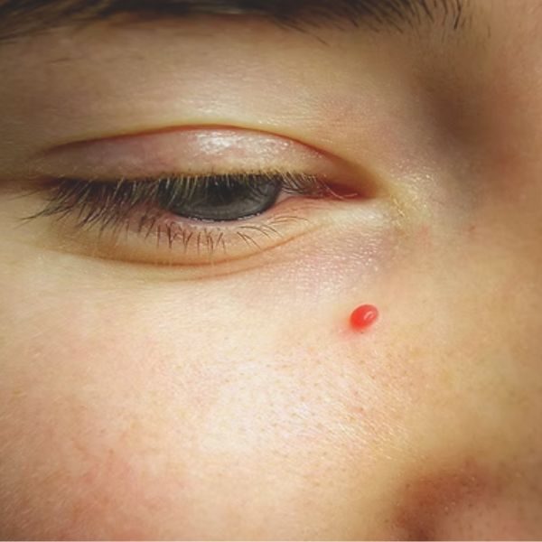 a cherry angiomas on a patients face at SF Aesthetics Daventry