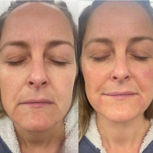 a before and after image of a marionette lines treatment. dermal filler marionette lines before and after