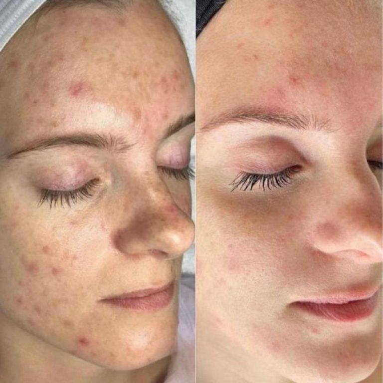 a before and after of a chemical peel facial.